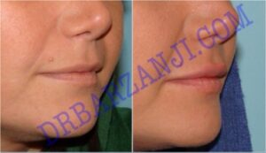 تزریق ژل رستیلن در لب