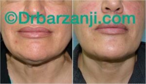 تزریق بوتاکس در گردن