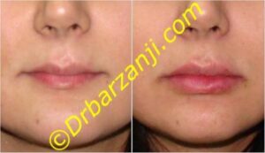 تزریق ژل در لب