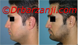 پروتز چانه یک هفته بعد از عمل