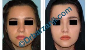 جراحی پلاستیک بینی نه ماه بعد از عمل