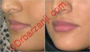 تزریق ژل جوویدرم ( ژوویدرم ) در لب ده روز بعد