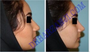 جراحی بینی ، ٣ ماه بعد از عمل