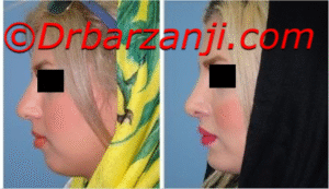 جراحی بینی و پروتز چانه و گونه شش ماه بعد
