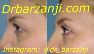 جراحی زیبایی پلک بالا ( بلفاروپلاستی )