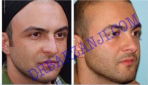 عمل جراحی پلاستیک بینی ٢ سال بعد