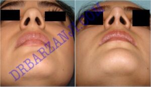 جراحی بینی ، ٣ ماه بعد از عمل