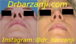 جراحی ترمیمی بینی دو هفته بعد از عمل