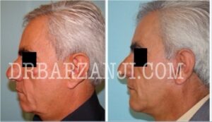 فیس لیفت و پروتز چانه