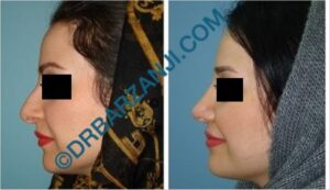 جراحی بینی یک سال بعد از عمل
