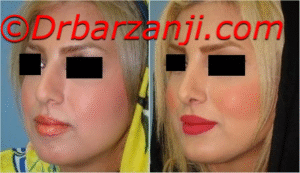 جراحی بینی و پروتز چانه و گونه شش ماه بعد
