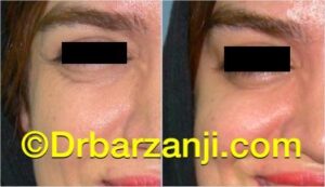 کاهش خطوط خنده کنار چشم با تزریق بوتاکس ( دیسپورت )