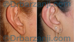 جراحی پلاستیک لاله گوش یک سال بعد از عمل