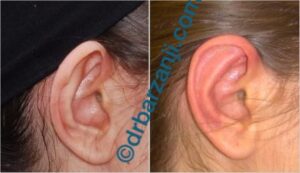 جراحی برجستگی لاله گوش