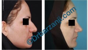 عمل جراحی پلاستیک بینی چهار سال بعد