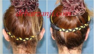 جراحی زیباییی لاله گوش ( اتوپلاستی )