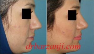 جراحی بینی کج