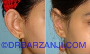 عمل جراحی پلاستیک لاله گوش