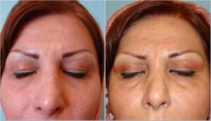 جراحی زیبایی پلک بالا،۳ سال بعد از عمل