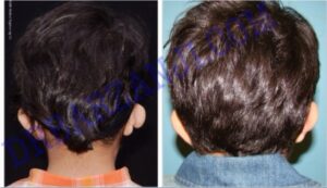 جراحی پلاستیک ناهنجاری لاله گوش راست