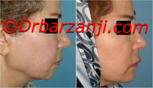 پروتز چانه با بهبود نسبی افتادگی پوست کنار چانه