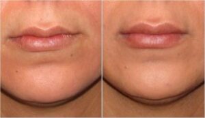 تزریق ژل جوویدرم در لب، ١٥ ماه بعد