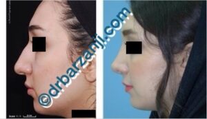 جراحی پلاستیک بینی یک سال بعد از عمل