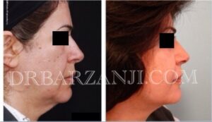 لیفت صورت و گردن