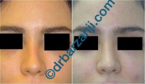 تزریق ژل رادیس در محل فرورفتگی بینی بعد از عمل