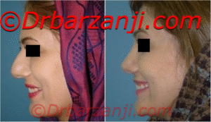 عکس قبل و بعد جراحی پلاستیک بینی شش ماه بعد