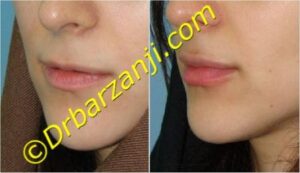 تزریق ژل لب