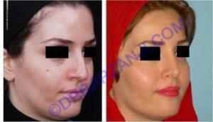 جراحی پلاستیک بینی، 4 سال بعد