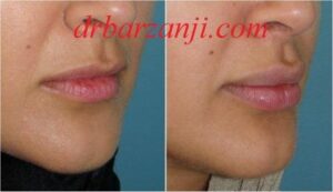 تزریق ژل جوویدرم در لب