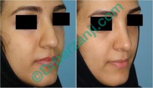 جراحی بینی ٦ ماه بعد از عمل