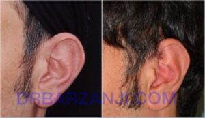 عمل جراحی پلاستیک برجستگی لاله گوش