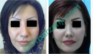 جراحی پلاستیک بینی هفت سال بعد از عمل