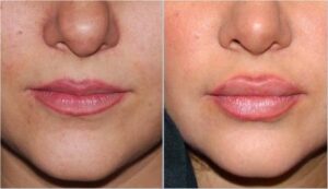 تزریق ژل جوویدرم در لب