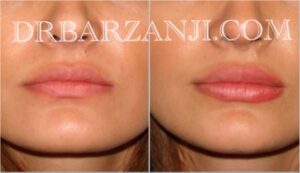 تزریق ژل رستیلن در لب