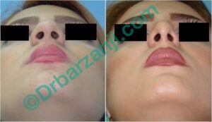 جراحی پلاستیک بینی شش ماه بعد از عمل