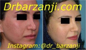 جراحی ترمیمی بینی چهار ماه بعد از عمل