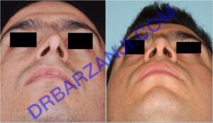 جراحی بینی، شش ماه بعد از عمل