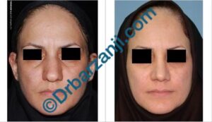 عمل جراحی پلاستیک بینی چهار سال بعد