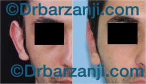 جراحی ترمیمی برجستگی لاله گوش