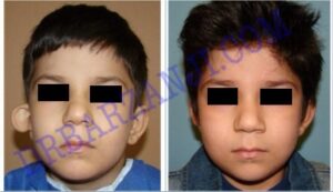 جراحی پلاستیک ناهنجاری لاله گوش راست