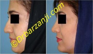 جراحی زیبایی بینی