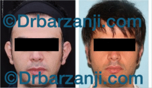 عمل جراحی پلاستیک برجستگی لاله گوش