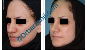 عمل جراحی پلاستیک بینی چهار سال بعد