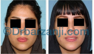 پروتز چانه و لیپوساکشن غبغب یک سال و نیم بعد