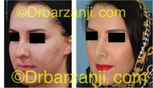 عمل جراحی زیبایی بینی یک سال بعد