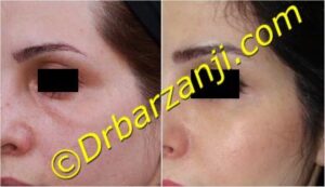 تزریق چربی زیر چشم ( ناودان اشکی )